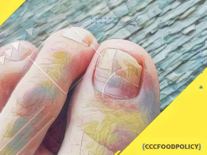 ciuperca unghiilor de la picioare