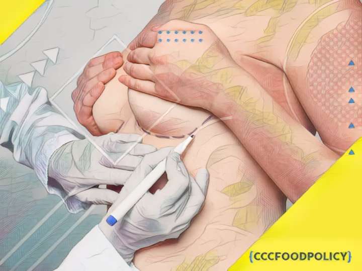 Chirurgie de marire a sanilor